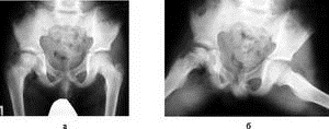 Болезнь пертеса тазобедренного сустава у детей рентген