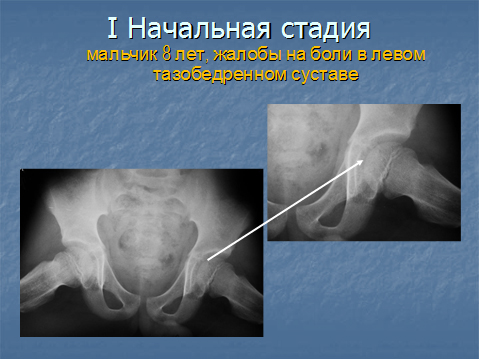 Болезнь пертеса тазобедренного сустава на рентгене