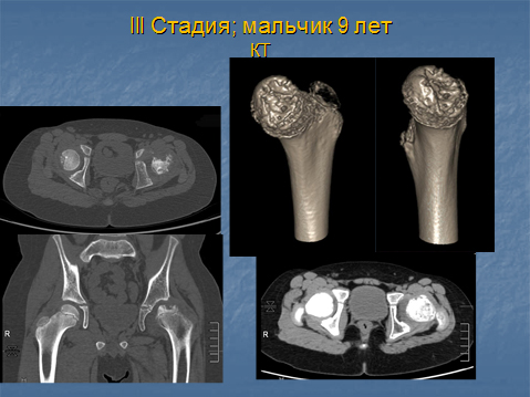 Болезнь пертеса тазобедренного сустава у детей рентген