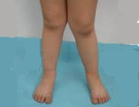 Лечение детей при х образных ногах